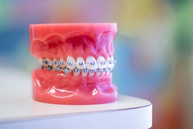 Metal Braces | Braces Daphne AL | Glass Orthodontics