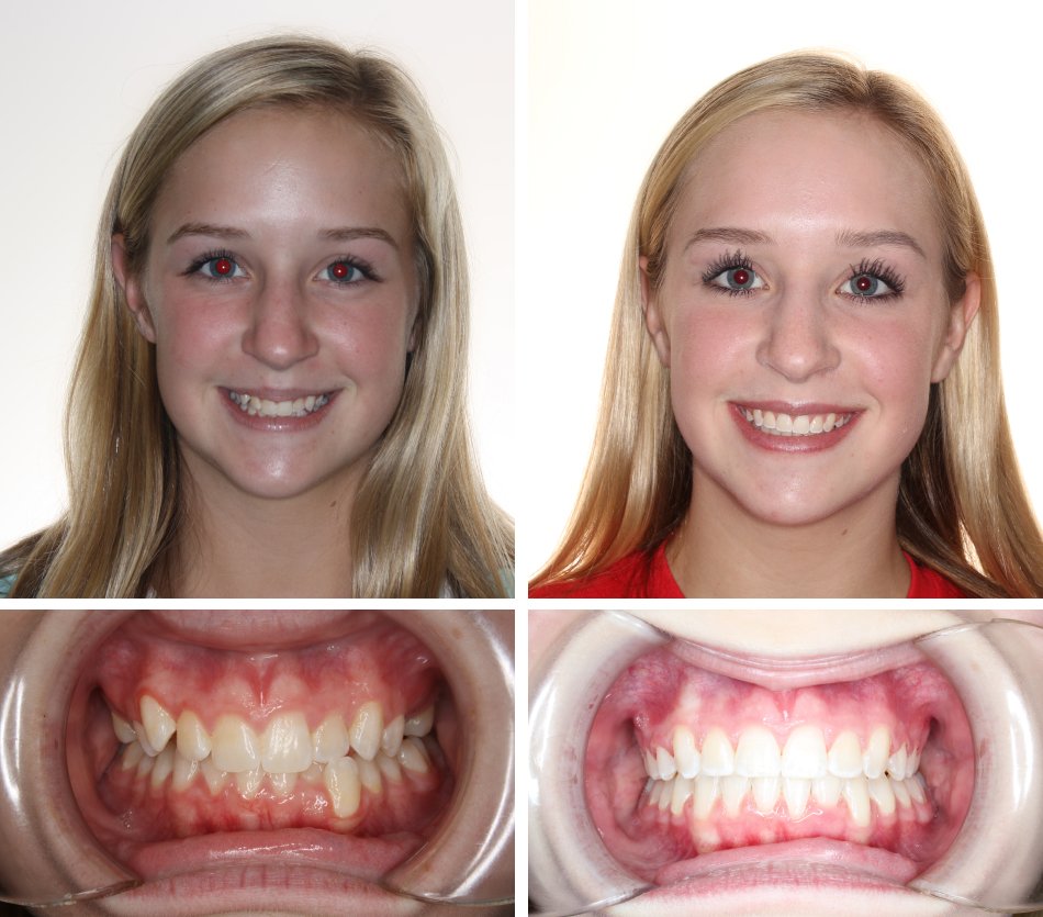 Glass Orthodontics before & after
