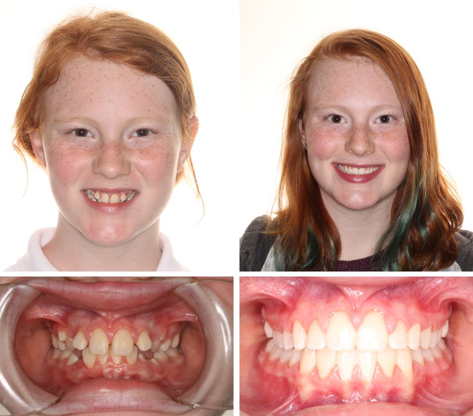 Glass Orthodontics before & after