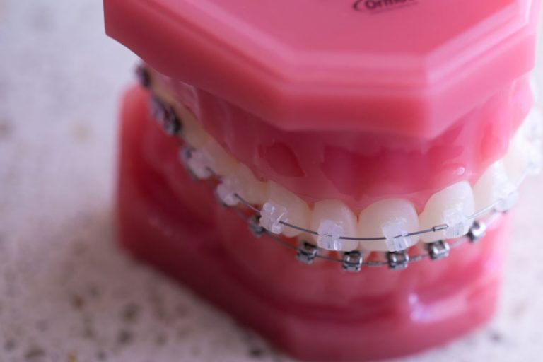 When Do Your Braces Come Off? 