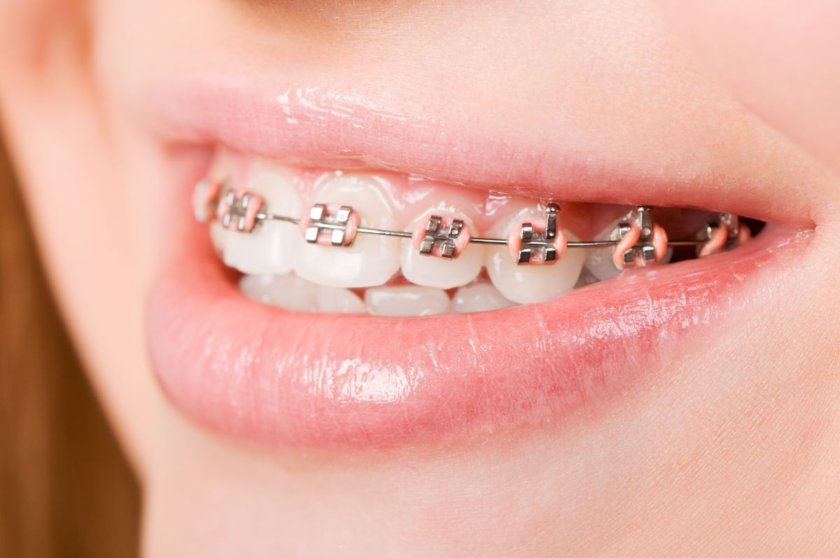 The Top Myths About Braces